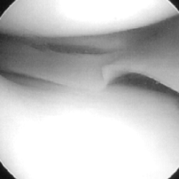 파열된 연골판 사진