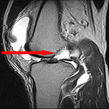 파열된 연골판 사진