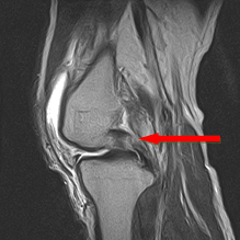 파열된 연골판 사진