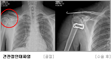 견관절인대파열 수술 전,후 사진