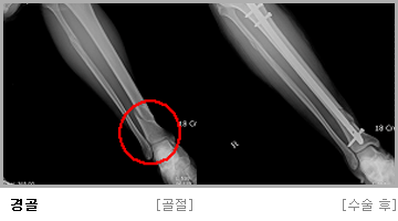 경골 수술 전,후 사진