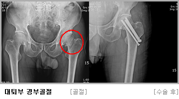 대퇴부 경부골절 수술 전,후 사진