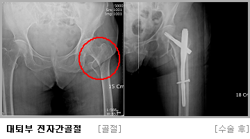 대퇴부 전자간골절  수술 전,후 사진