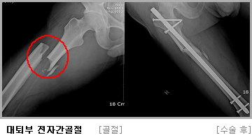 대퇴부 수술 전,후 사진