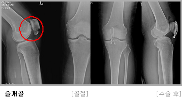 슬개골 수술 전,후 사진