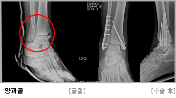 양과골 수술 전,후 사진