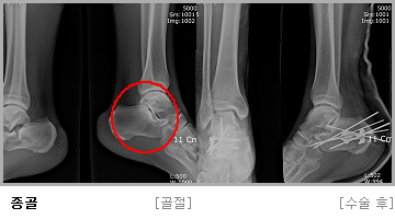 종골 수술 전,후 사진