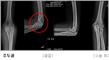 주두골 수술 전,후 사진