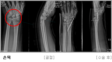 손목 수술 전,후 사진