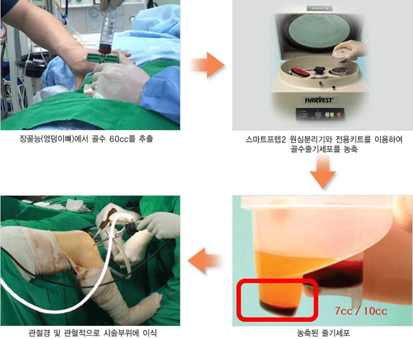 정상연골판 사진