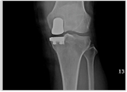 최초침습 반치환술 수술후 X-ray