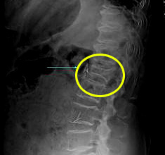 골다공증성 척추 압박골절 사진