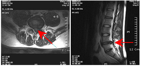 제 4-5번 디스크 탈출상태 (MRI)