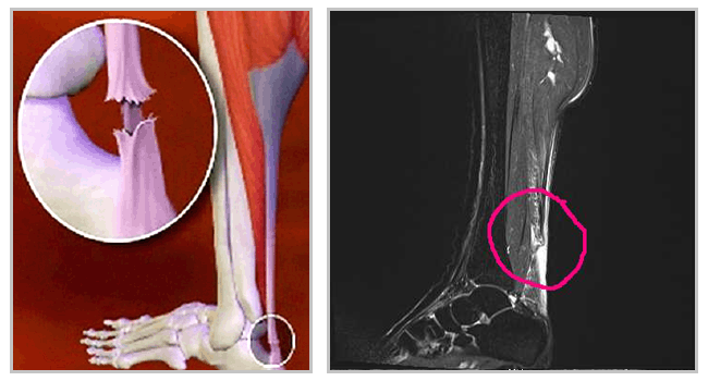 아킬레스건이 파열된 모습