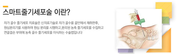 스마트줄기세포술이란? 자가 골수 줄기세포 치료술은 신의료기술로 자가 골수를 골반에서 채취한후, 원심분리기를  사용하여  원심 분리를 시행하고,분리된 농축 줄기세포를 수집하고 연골결손 부위에 농축 골수 줄기세포를 이식하는 수술법입니다 