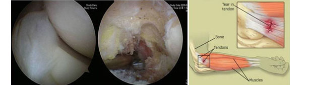 테니스엘보 관절내시경
