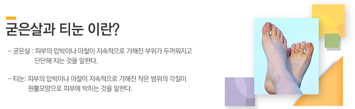 굳은살 :피부의 압박이나 마찰이 지속적으로 가해진 부위가 두꺼워지고 단단해 지는 것을 말한다. 티눈:피부의 압박이나 마찰이 지속적으로 가해진 작은 범위의 각질이 원뿔모양으로 피부에 박히는 것을 말한다. 