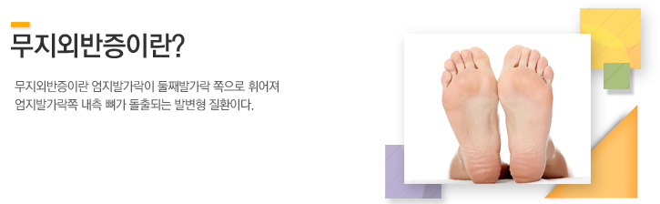 무지외반증이란 엄지발가락이 둘째발가락 쪽으로 휘어져 엄지발가락쪽 내측 뼈가 돌출되는 발변형 질환이다.