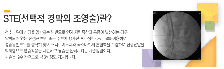 척추부위에 신경을 압박하는 병변으로 인해 저림증상과 통증이 발생하는 경우 압박되어 있는 신경근 뿌리 또는 주변에 방사선 투시장비(C-arm)를 이용하여
								통증유발부위를 정확히 찾아 스테로이드제와 국소마취제 혼합액을 주입하여
								신경전달을 억제함으로 염증작용을 차단하고 통증을 완화시키는 시술방법이다.