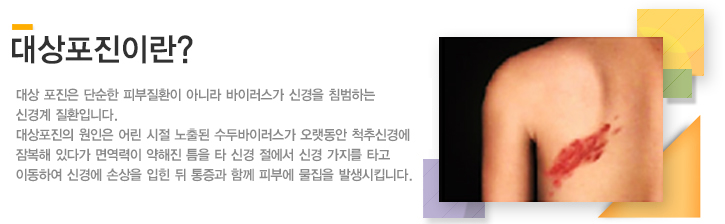 http://www.lct.co.kr/sub04/sub0415_5.php 전문센터 > 비수술적신경치료센터 > 대상포진