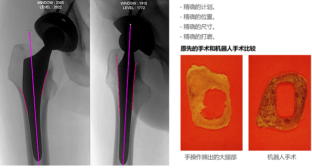 Robodoc Surgery