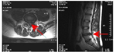 第4-5号 间盘突出状态（MRI)  사진