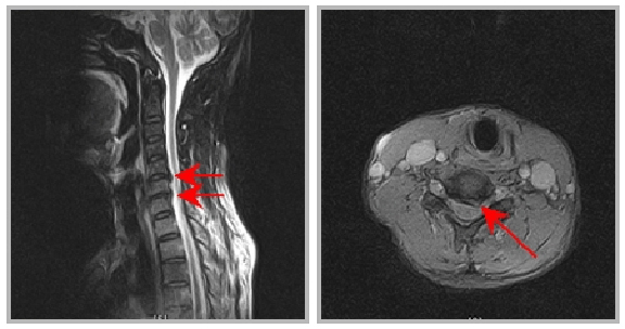 CERVICAL 사진