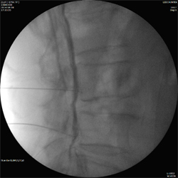 Damaged Archilles Tendon 손상 사진