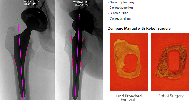 Robodoc Surgery