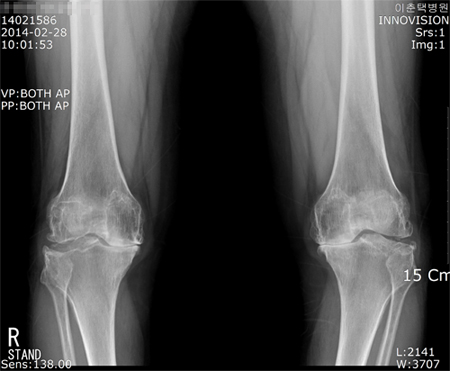 Degenerative Arthritis