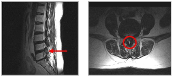 4~5  lumbar Spinal Canal Stenosis 사진