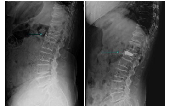 Epidural Leakage 사진