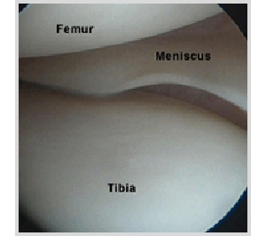 Meniscus Tear사진