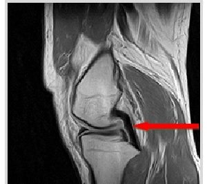 Posterior Cruciate Ligament Rupture 사진