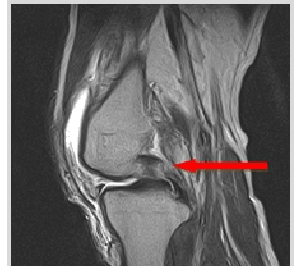 Posterior Cruciate Ligament Rupture 사진