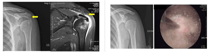 Calcification Tendinitis