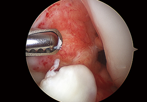 Arthroendoscopy Surgery