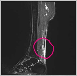 Damaged Archilles Tendon 손상 사진