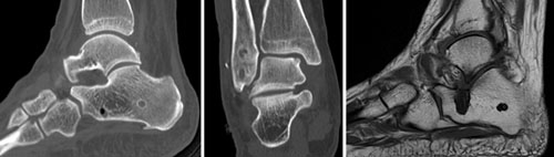 Foot Joint Ligament Damage