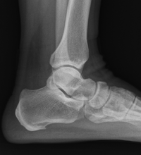 Plantar Fasciitis 손상 사진