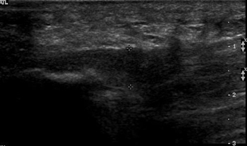 Plantar Fasciitis 손상 사진