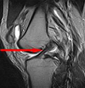 반월상연골판파열 사진