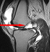 반월상연골판파열 사진