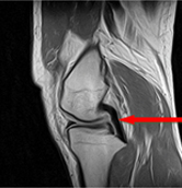 반월상연골판파열 사진