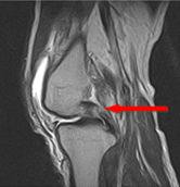 반월상연골판파열 사진